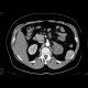 Tumour of the left adrenal gland, adenoma: CT - Computed tomography